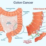 Colorectal Cancer