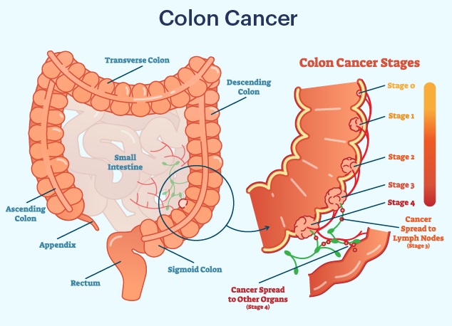 Colorectal Cancer