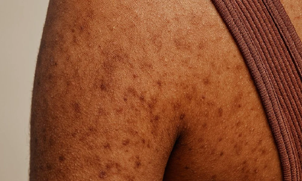 Acne on body