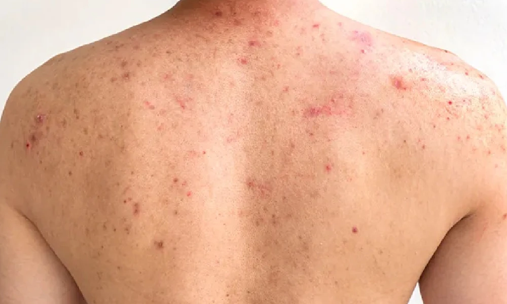 Acne on body