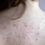 Acne on body