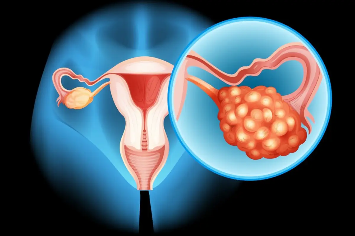 Ovarian Cancer