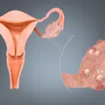 PCOS Problem